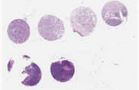 TNBC (E1, F1, G1, H1)