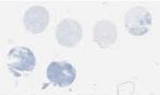 TNBC (E1, F1, G1, H1)