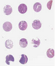 NSCLC (A2, B2, C2, D2)