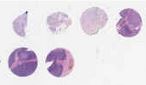 HNSCC (E4, F4, G4, H4)