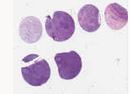 TNBC<br>(E1, F1, G1, H1)