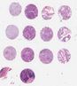 NSCLC<br>(A2, B2, C2, D2)