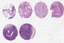 NSCLC<br>(E2, F2, G2, H2)
