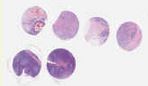 TNBC (E1, F1, G1, H1)
