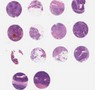 TNBC (A1, B1, C1, D1)