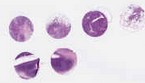 TNBC (E1, F1, G1, H1)