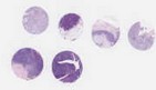 TNBC (E1, F1, G1, H1)