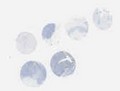 TNBC (E1, F1, G1, H1)