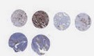 NSCLC (E2, F2, G2, H2)
