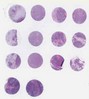 TNBC (A1, B1, C1, D1)