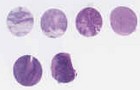 TNBC (E1, F1, G1, H1)