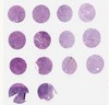 NSCLC (A2, B2, C2, D2)