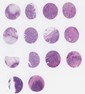 TNBC (A1, B1, C1, D1)