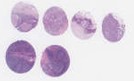 TNBC (E1, F1, G1, H1)