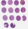 NSCLC (A2, B2, C2, D2)